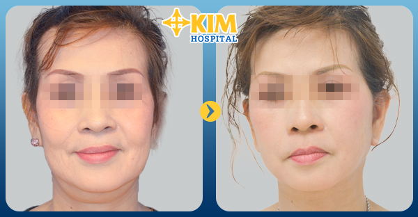 Hình ảnh trước và sau khi căng da mặt bằng chỉ vàng tại Bệnh viện thẩm mỹ Hàn Quốc.