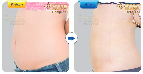 Hình ảnh khách hàng trước và sau khi hút mỡ tại bệnh viện thẩm mỹ KIM. Lưu ý: Hiệu quả Hút mỡ không phẫu thuật tùy thuộc vào cơ địa mỗi người.
