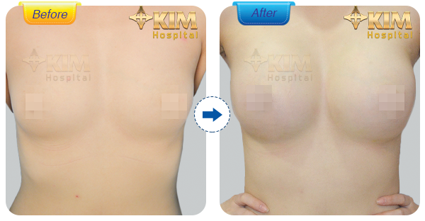 Hình ảnh trước và sau nâng ngực tại KIM Hospital. Lưu ý thời gian và kết quả thẩm mỹ sẽ phụ thuộc vào cơ địa của mỗi khách hàng.